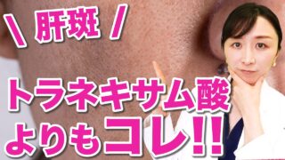 【トラネキサム酸よりもこれ】肝斑におすすめスキンケア成分トップ５を皮膚科医が解説